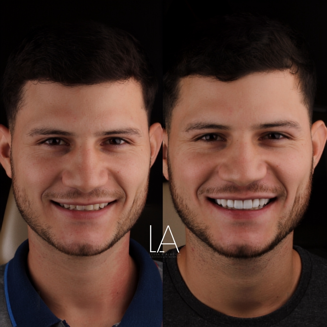 Antes e depois — caso 2