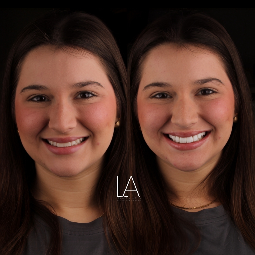 Antes e depois — caso 4